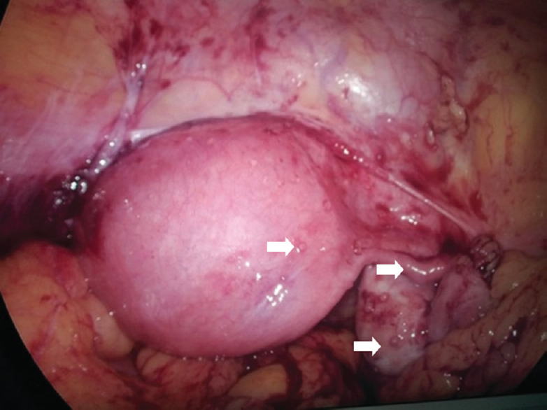 Laparoscopy showing tubercles on uterus, fallopian tubes and ovaries (arrows).